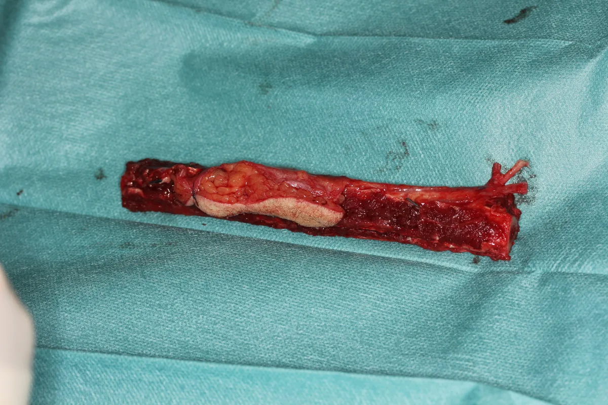 Reconstrucción microquirúrgica de una pérdida ósea del antebrazo (imagen quirúrgica 1)