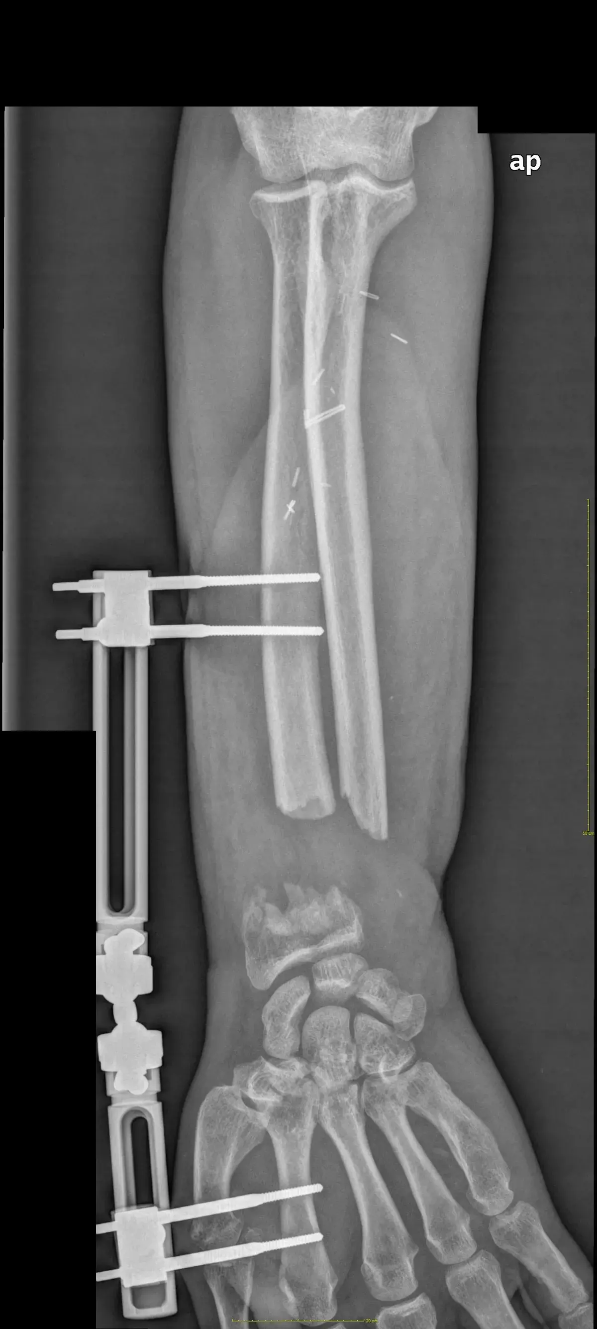 Radiografía del antebrazo con fijador externo tras la primera cirugía