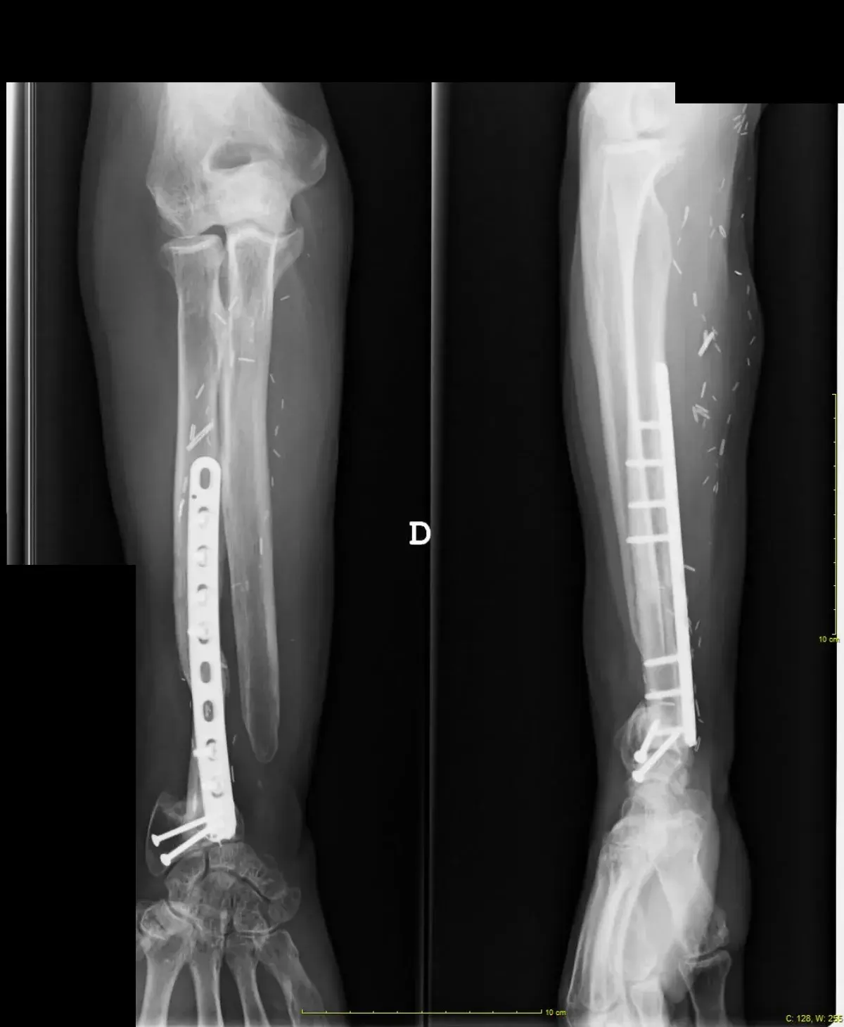 Radiografía del antebrazo reconstruido con peroné vascularizado y placa
