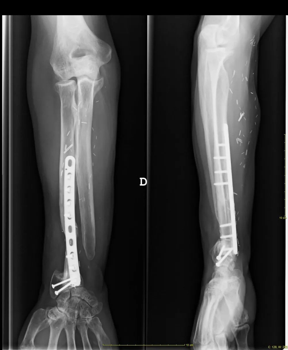 Radiografía de un antebrazo reconstruido con peroné vascularizado