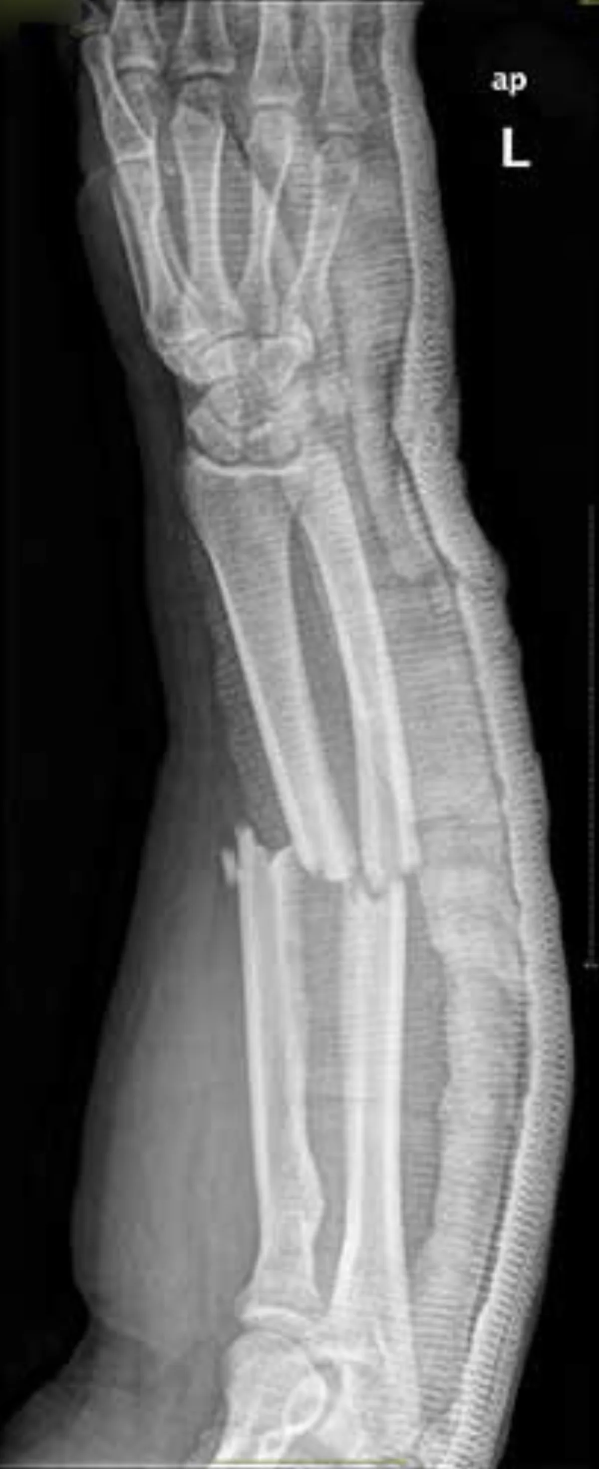 Radiografía inicial de la fractura cerrada de ambos huesos del antebrazo