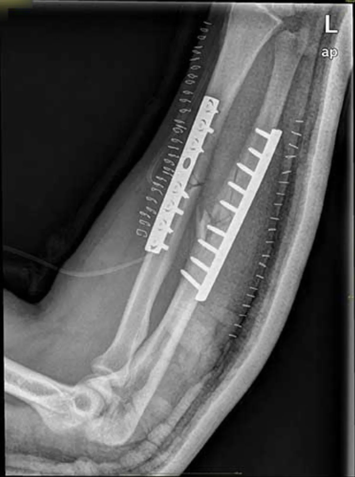 Fractura sintetizada con placa y tornillos