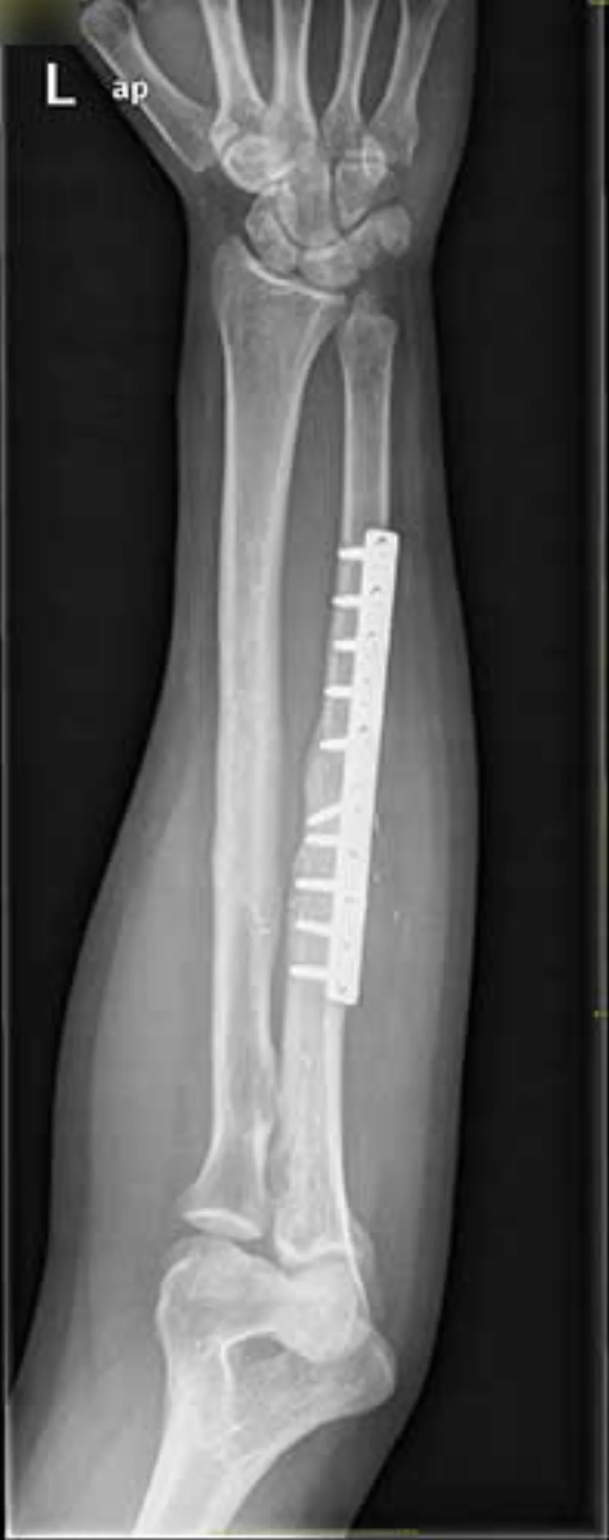Radiografía del antebrazo con la fractura consolidada tras la reconstrucción