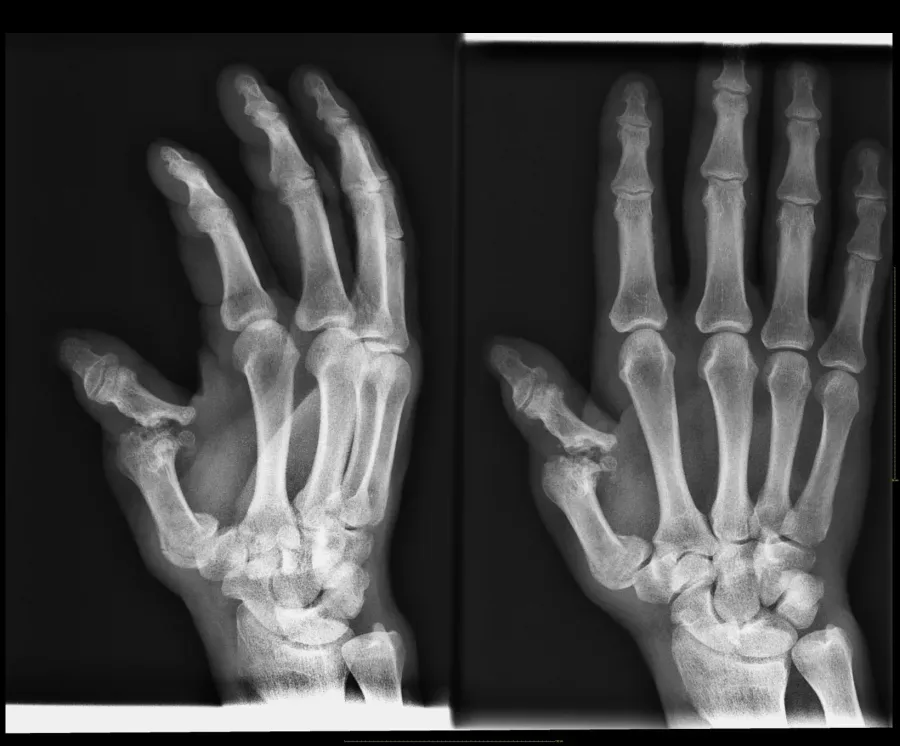 Radiografía de un pulgar con pseudoartrosis