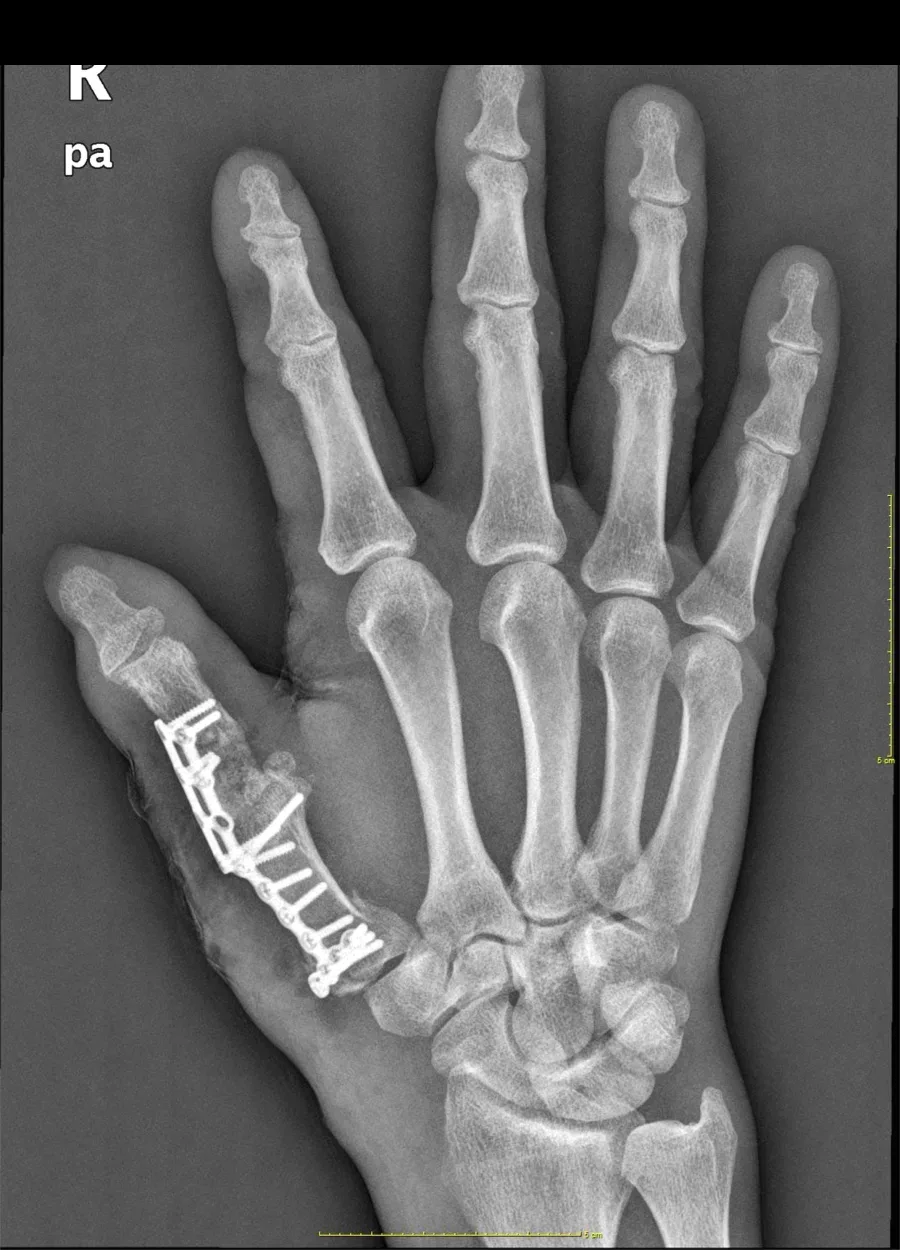 Radiografía del pulgar consolidado tras el colgajo de hueso vascularizado