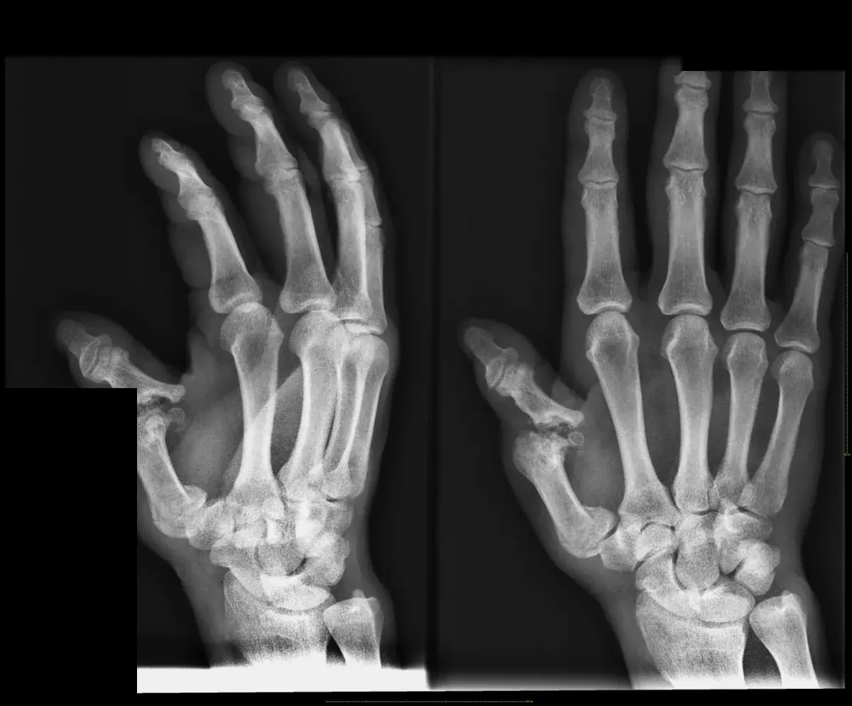 Radiografía inicial del pulgar antes de la reconstrucción