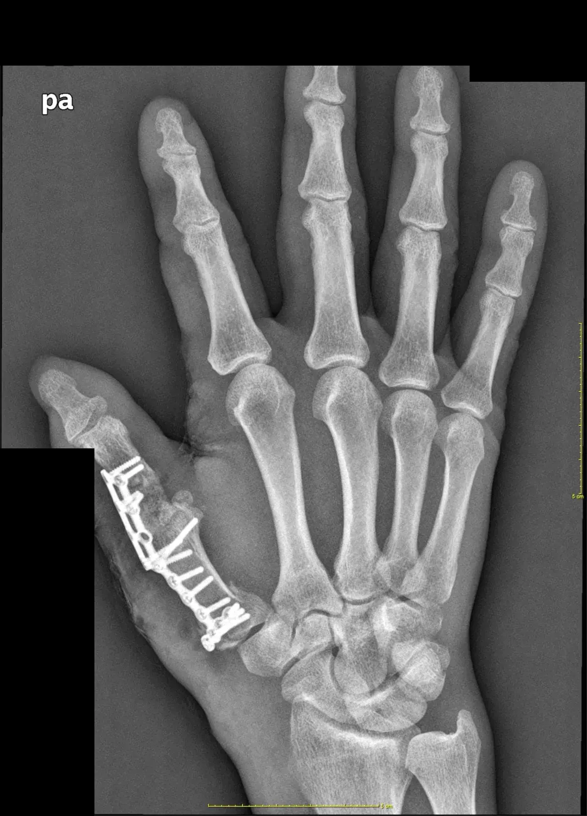 Radiografía tras la fijación con placa y tornillos