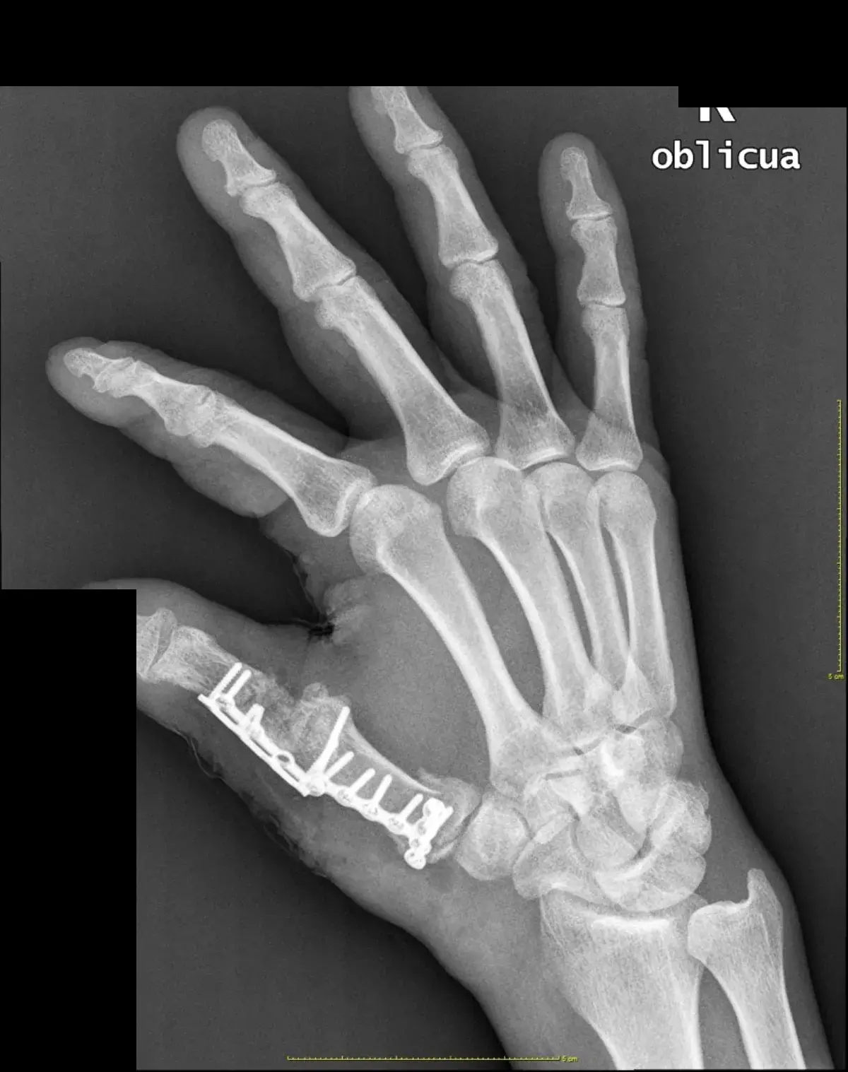 Radiografía oblicua con la placa de osteosíntesis