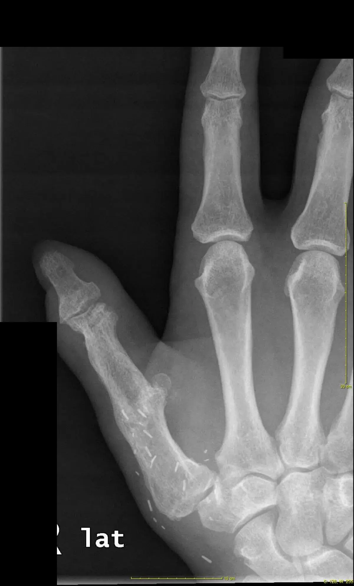 Radiografía lateral del pulgar reconstruido