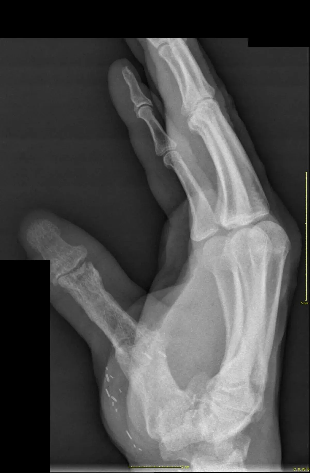 Radiografía del pulgar consolidado tras el injerto de hueso vascularizado