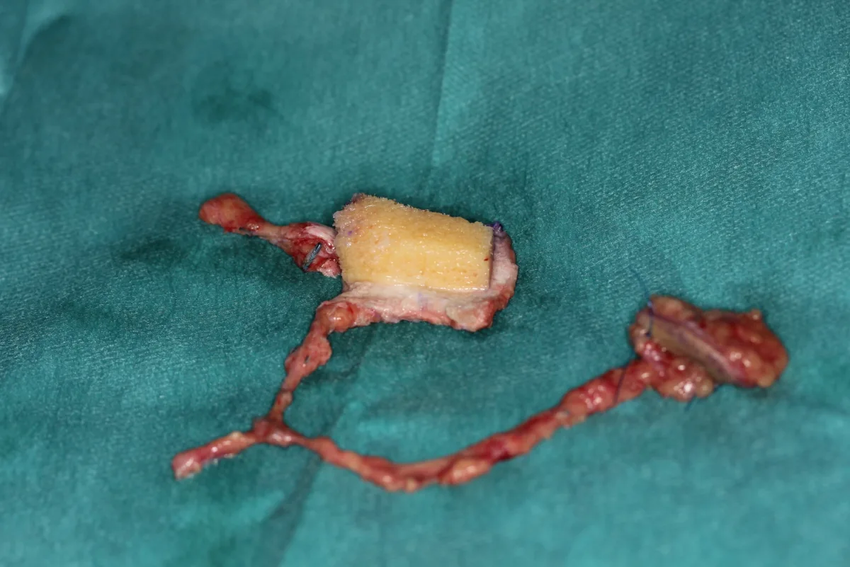 Injerto de hueso vascularizado durante la cirugía de reconstrucción del pulgar