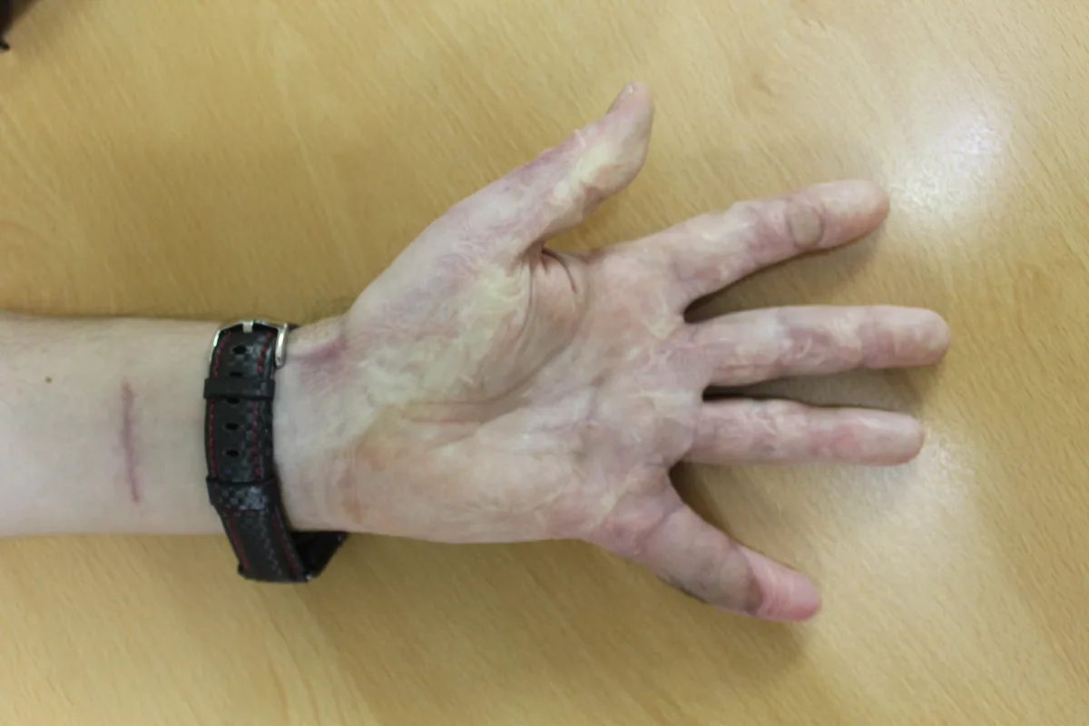 Mano con la extensión del quinto dedo recuperada tras la reconstrucción