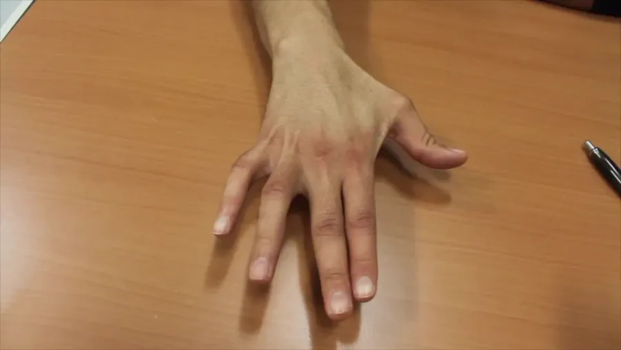 Mano tras la reconstrucción del nervio cubital