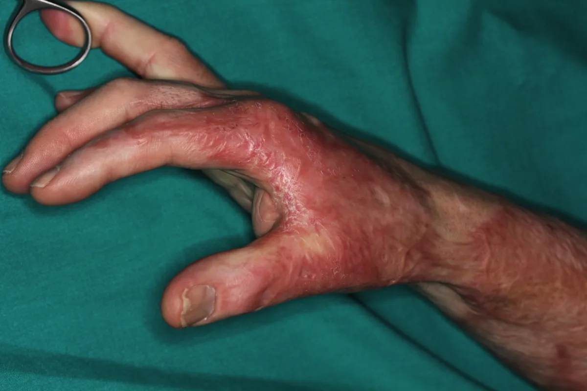 Reconstrucción microquirúrgica de secuelas de quemaduras en la mano (imagen quirúrgica 1)