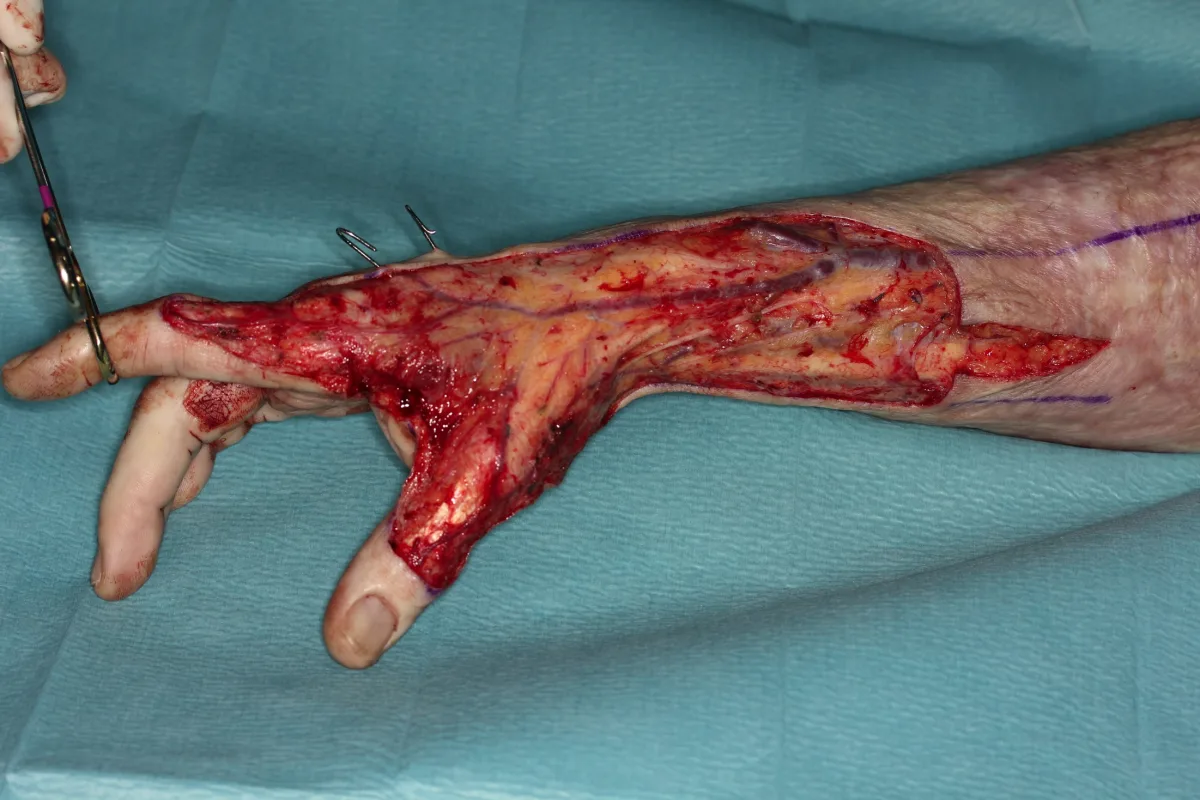 Reconstrucción microquirúrgica de secuelas de quemaduras en la mano (imagen quirúrgica 3)