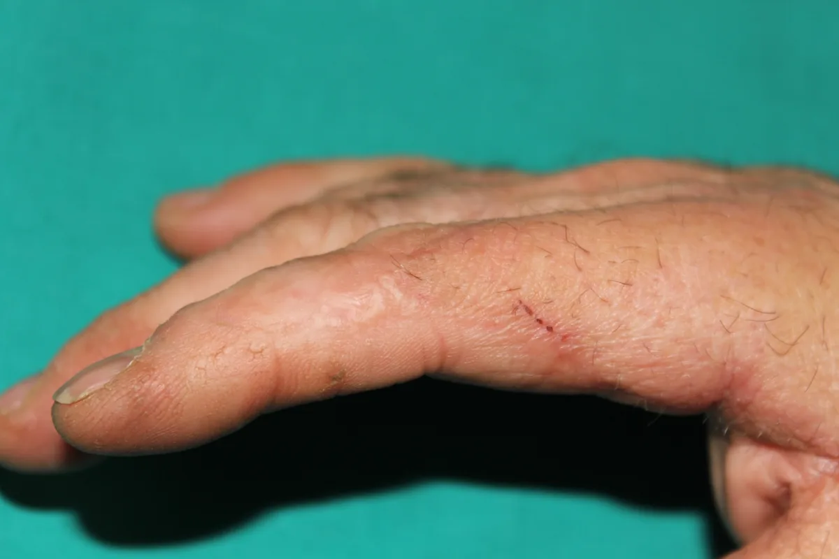 Reconstrucción microquirúrgica de secuelas de quemaduras en la mano (imagen quirúrgica 4)