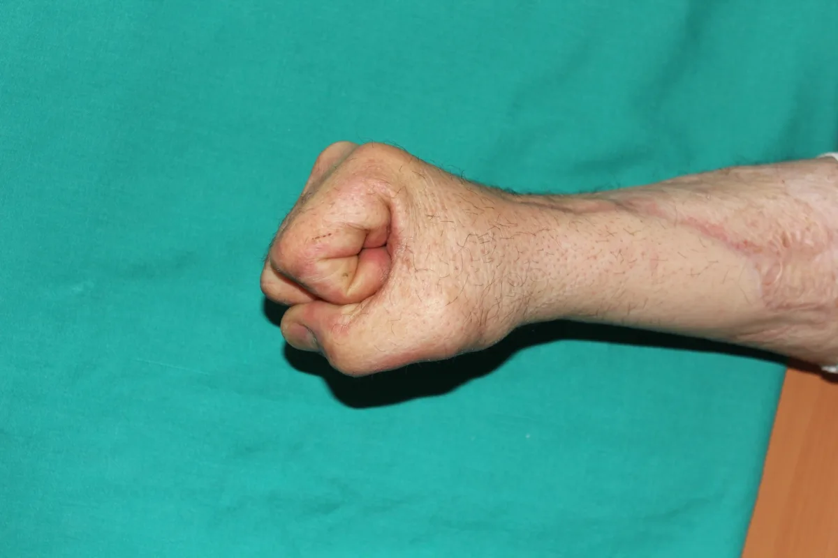 Reconstrucción microquirúrgica de secuelas de quemaduras en la mano (imagen quirúrgica 5)