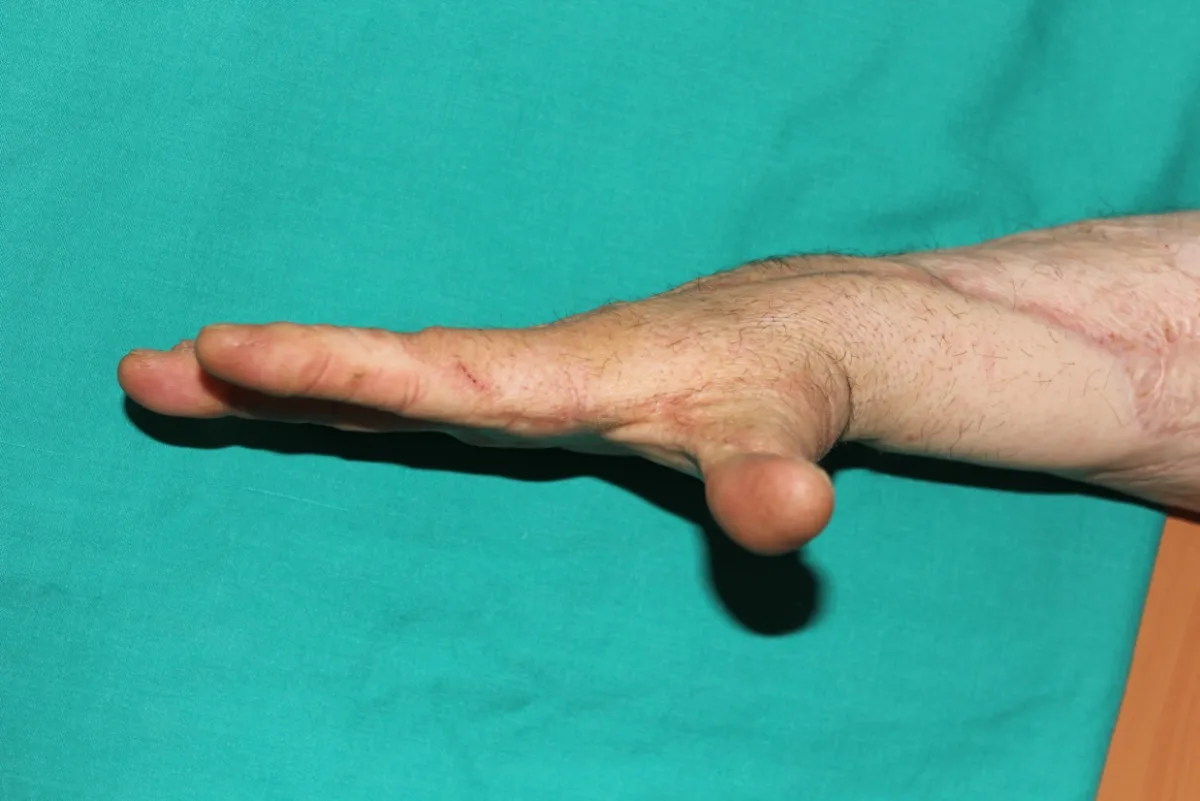 Reconstrucción microquirúrgica de secuelas de quemaduras en la mano (imagen quirúrgica 6)