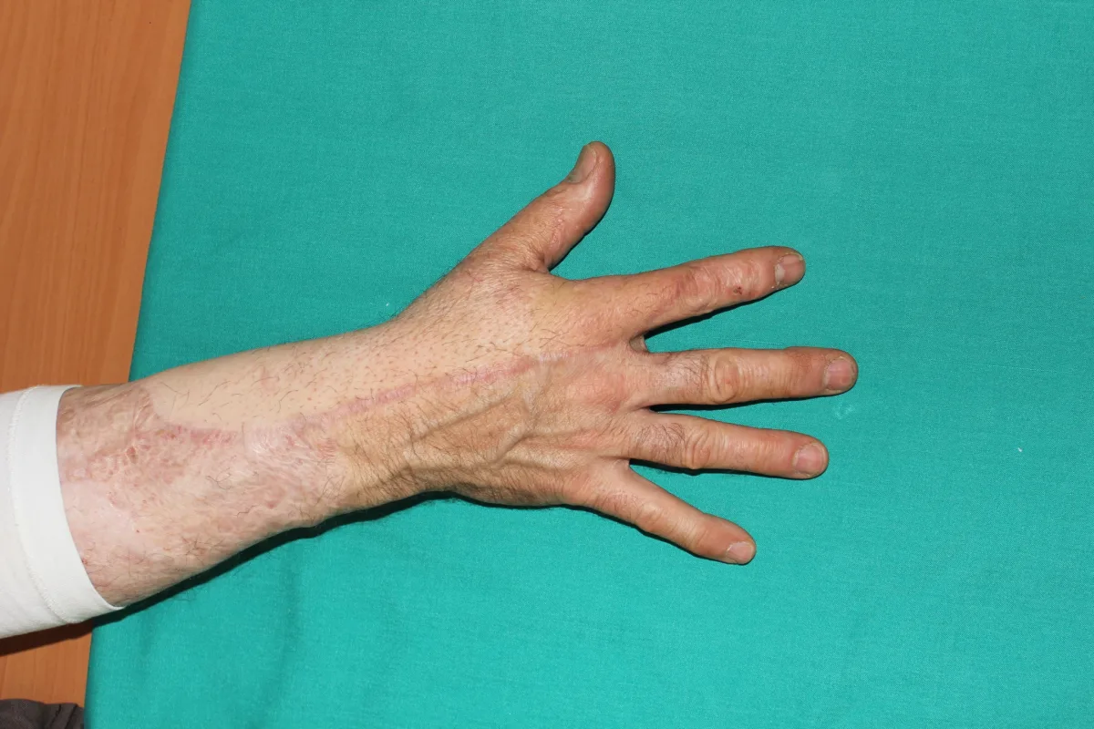 Reconstrucción microquirúrgica de secuelas de quemaduras en la mano (imagen quirúrgica 9)