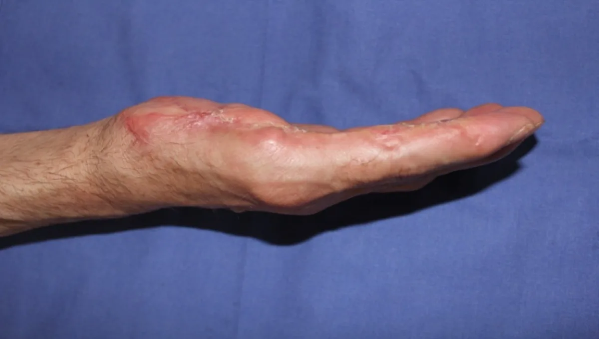 Reconstrucción de pulgar por doble transferencia de dedos del pie (imagen quirúrgica 1)