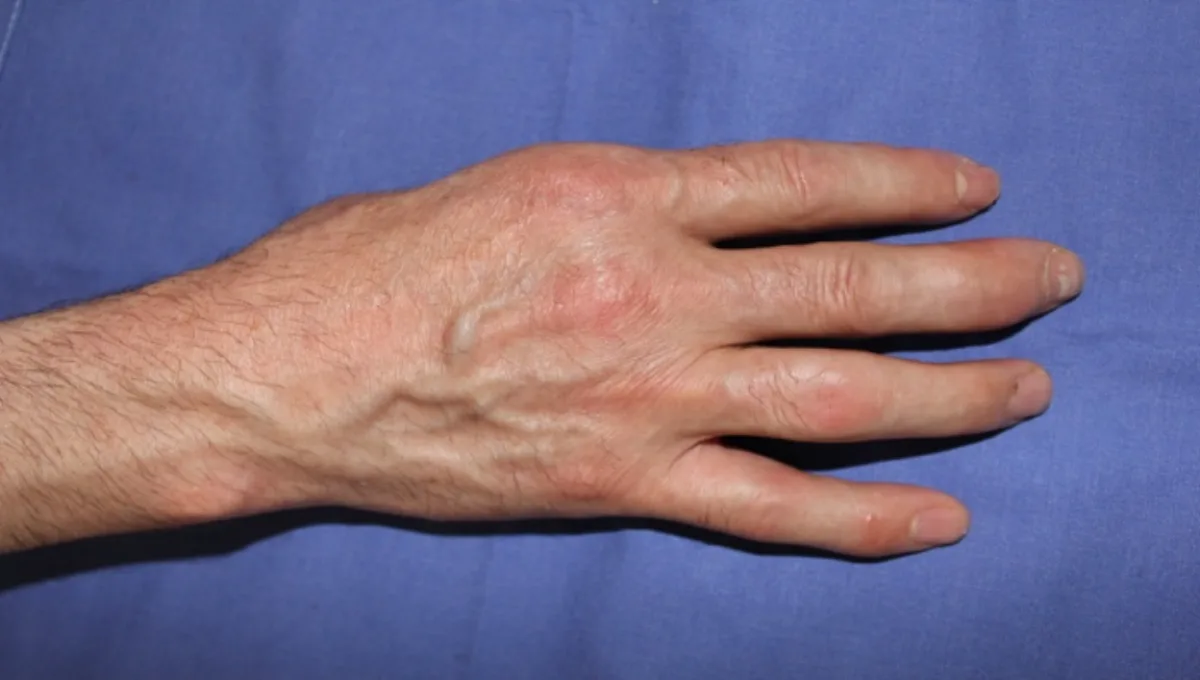 Reconstrucción de pulgar por doble transferencia de dedos del pie (imagen quirúrgica 2)