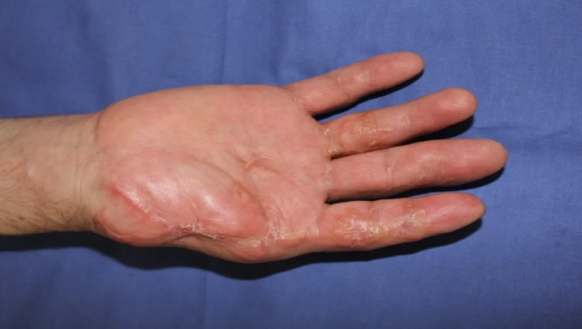 Reconstrucción de pulgar por doble transferencia de dedos del pie (imagen quirúrgica 3)