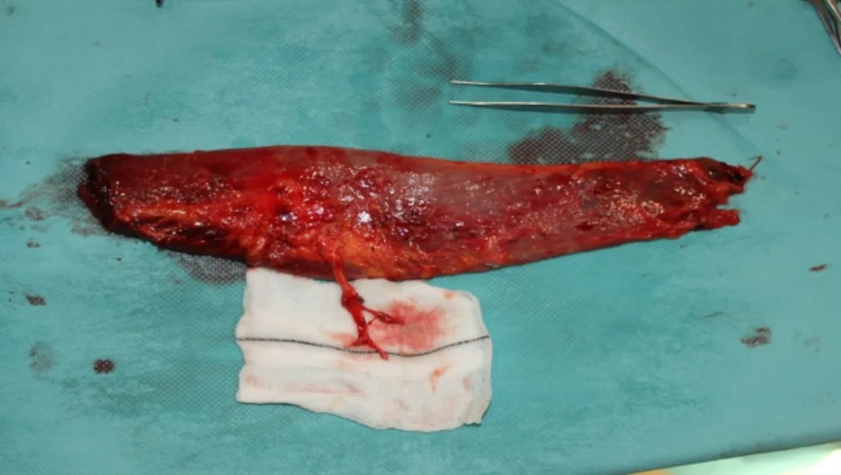 Reconstrucción de pulgar por doble transferencia de dedos del pie (imagen quirúrgica 5)