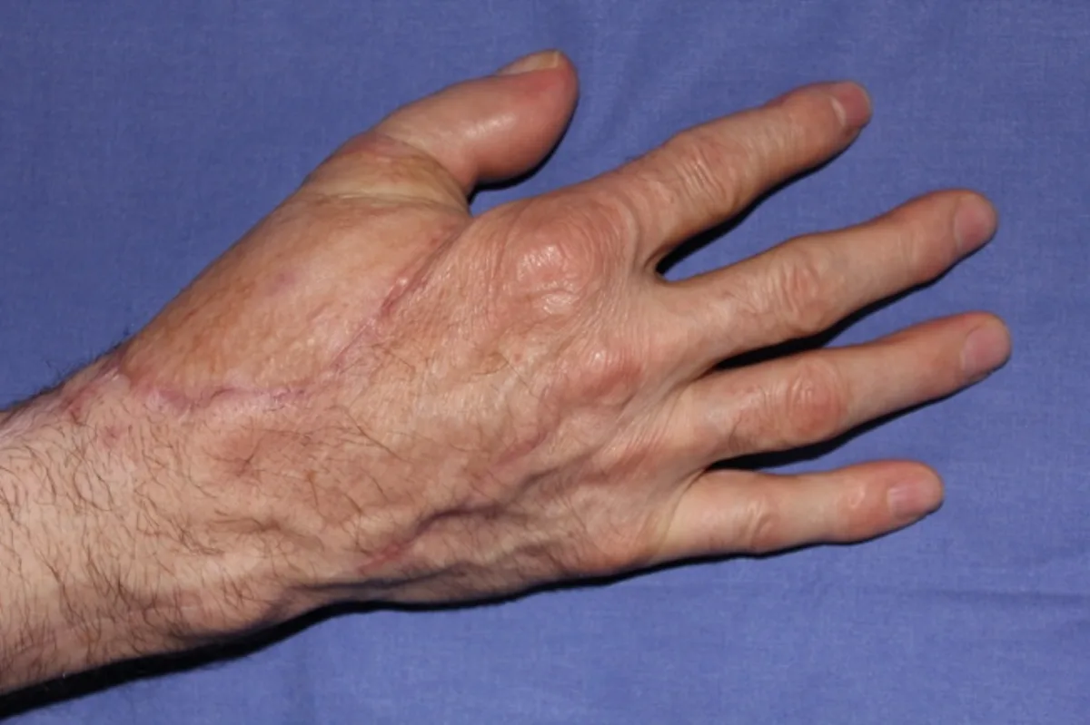 Reconstrucción de pulgar por doble transferencia de dedos del pie (imagen quirúrgica 6)
