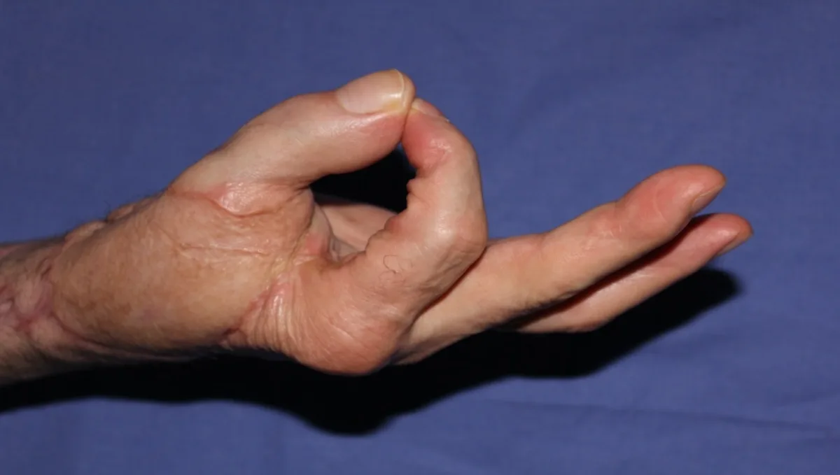 Pulgar reconstruido realizando la pinza con el índice