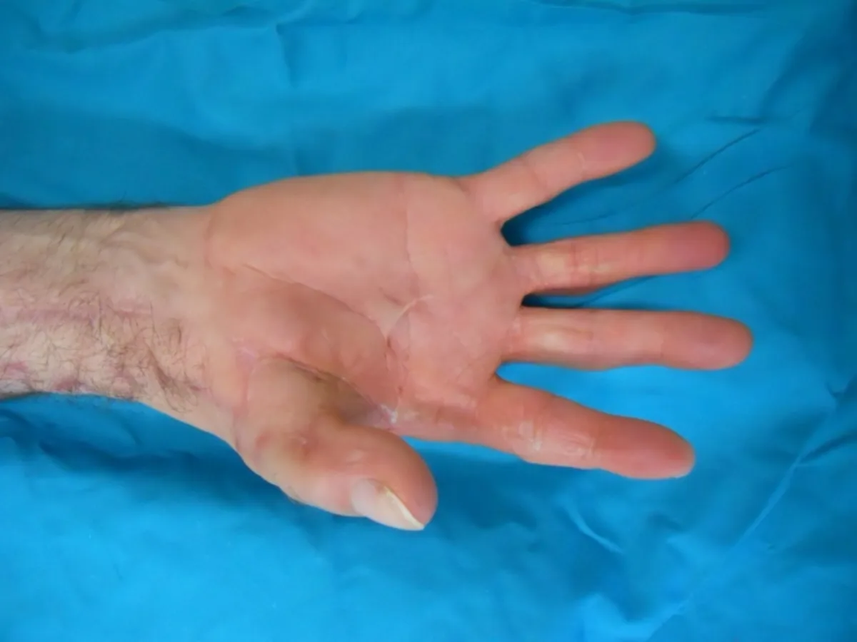 Reconstrucción de pulgar por doble transferencia de dedos del pie (imagen quirúrgica 8)