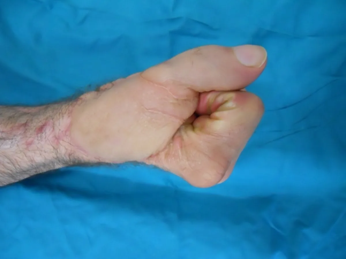 Reconstrucción de pulgar por doble transferencia de dedos del pie (imagen quirúrgica 9)
