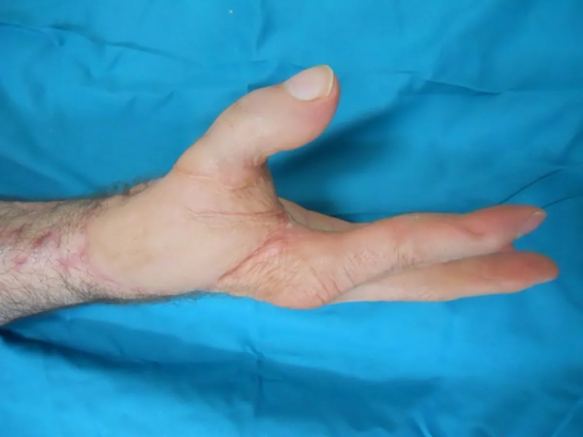Mano con el pulgar reconstruido mediante transferencia de dedos del pie