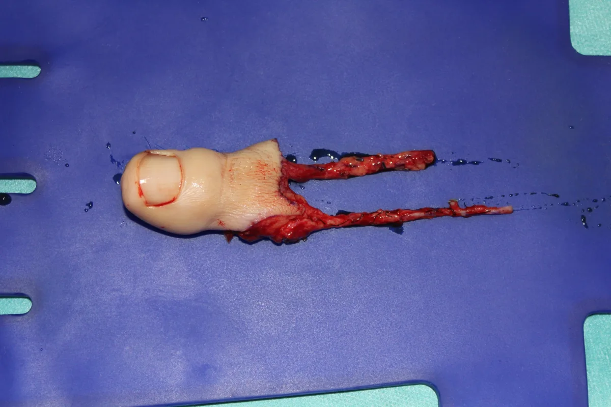 Disección del primer dedo del pie con su pedículo vascular