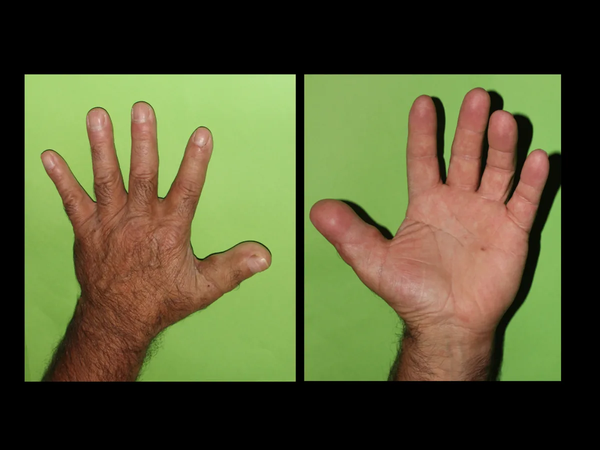 Resultado de la mano tras la transferencia, en dorso y palma