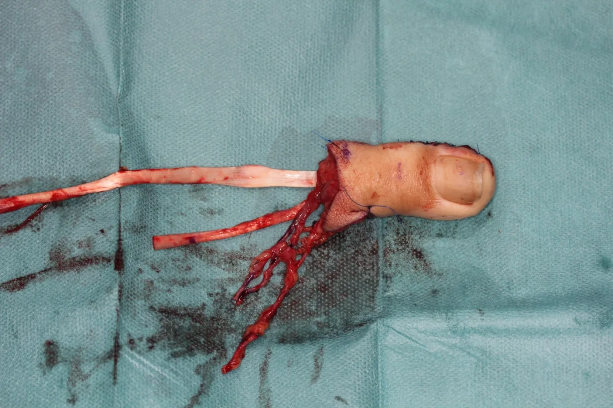 Reconstrucción del pulgar tras el fracaso de un reimplante (imagen quirúrgica 2)