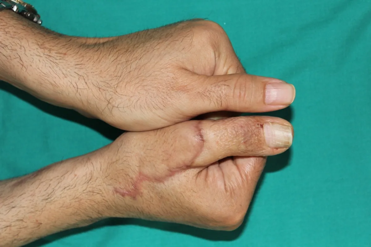 Manos comparadas tras la reconstrucción del pulgar