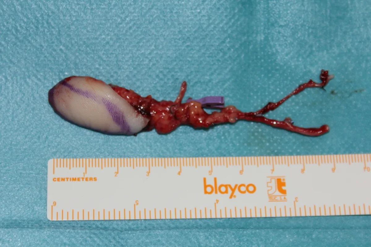 Reconstrucción del pulpejo del pulgar tras una infección (imagen quirúrgica 2)