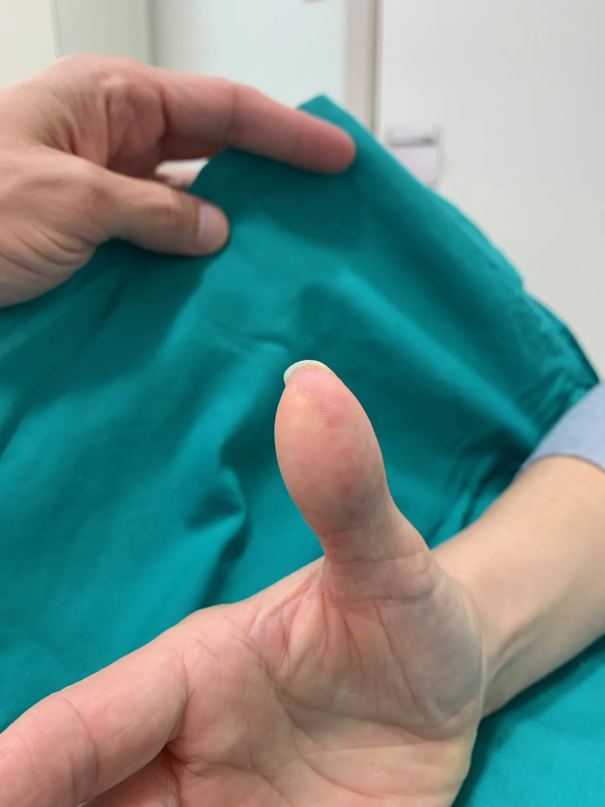 Reconstrucción del pulpejo del pulgar tras una infección (imagen quirúrgica 3)