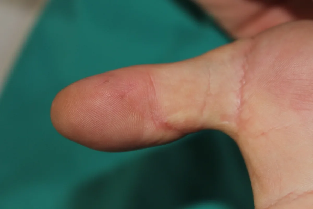 Pulpejo del pulgar reconstruido, con un contorno y una piel muy similares al original