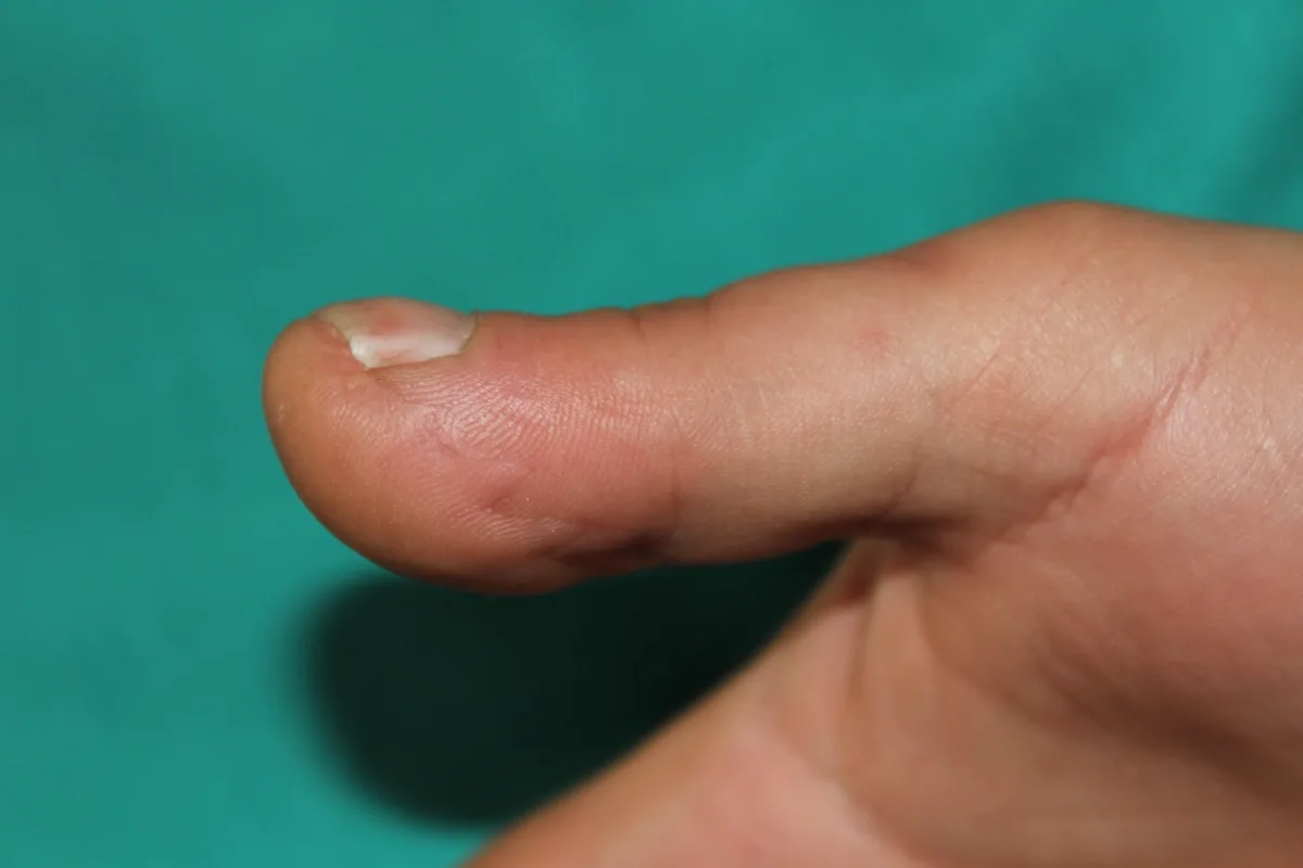Reconstrucción del pulpejo del pulgar (imagen quirúrgica 4)