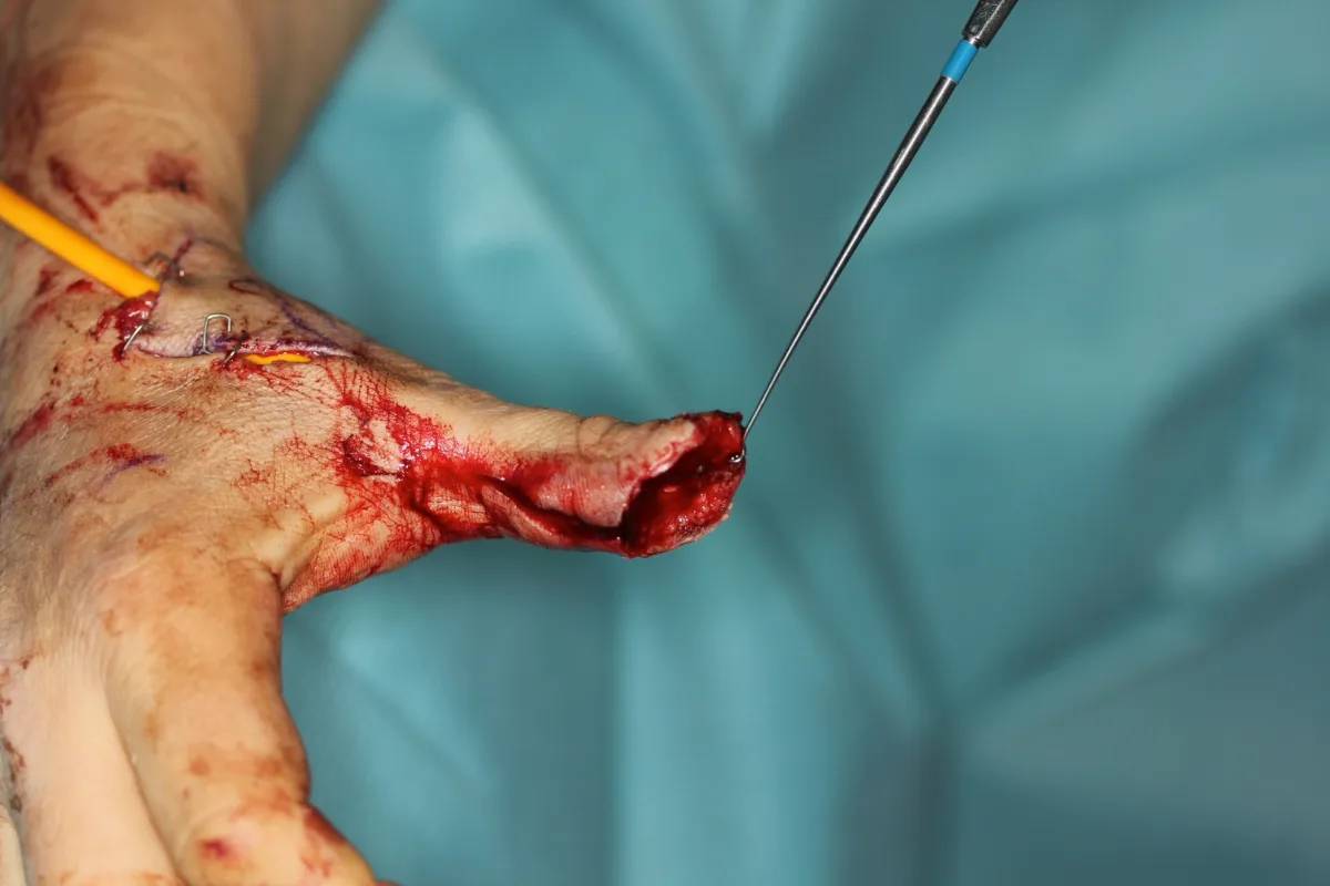 Reconstrucción del pulpejo del pulgar (imagen quirúrgica 6)