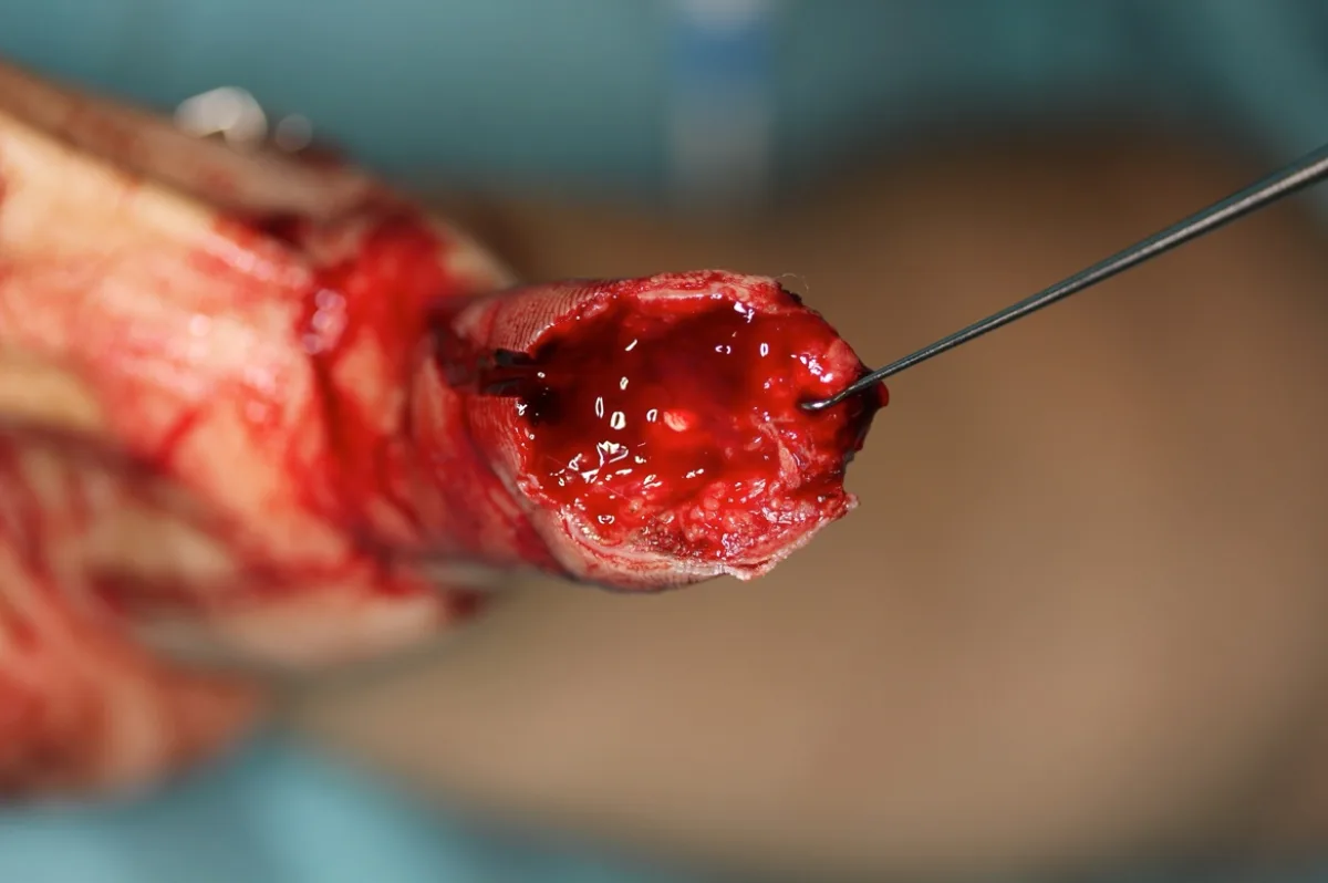 Reconstrucción del pulpejo del pulgar (imagen quirúrgica 7)