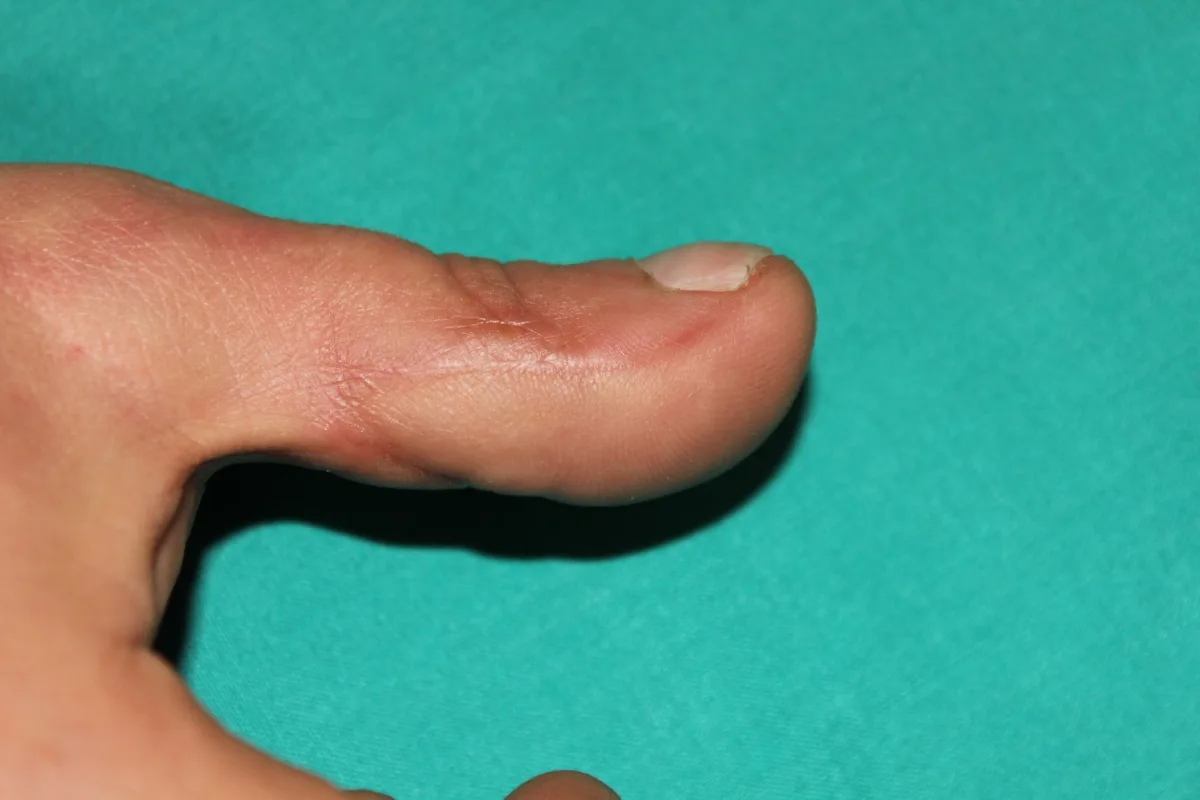 Reconstrucción del pulpejo del pulgar (imagen quirúrgica 8)