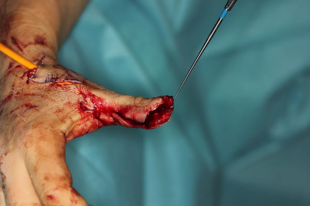 Reconstrucción del pulpejo del pulgar (imagen quirúrgica 9)