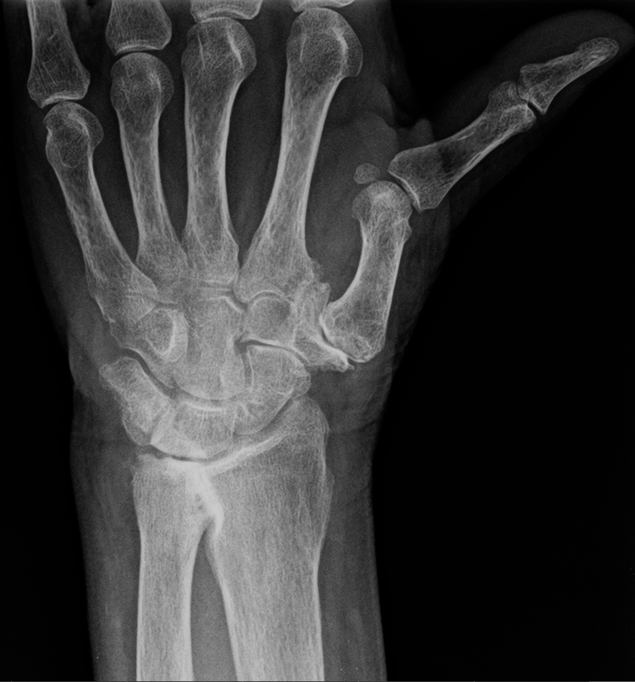 Radiografía de artrosis trapeciometacarpiana en la base del pulgar